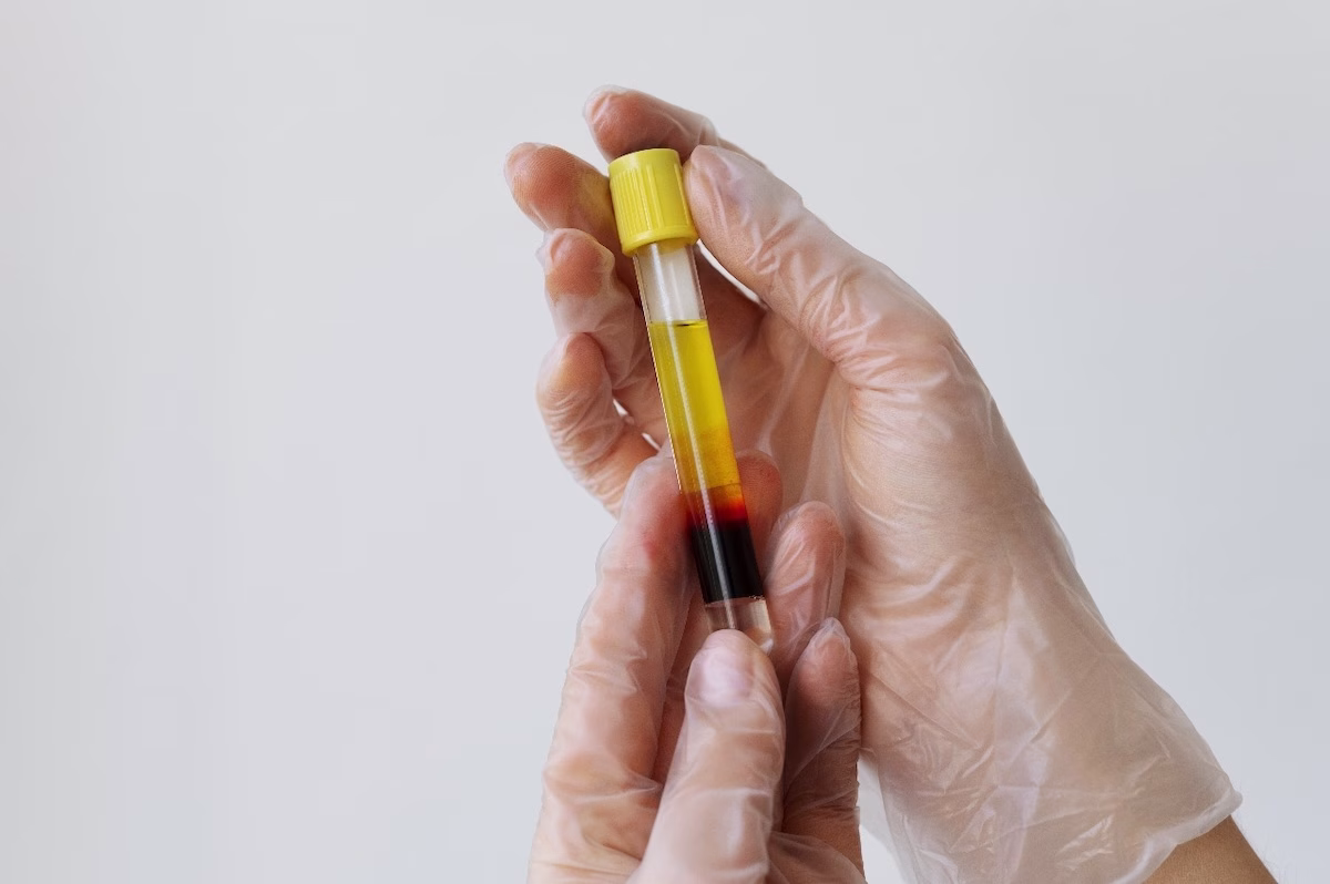 Suero Rico en Factores más Ácido Hialurónico (SRF+): La innovación tecnológica en salud que se abre paso en Chile Suero Rico en Factores más Ácido Hialurónico